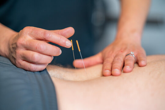 Dry-Needling_align-1