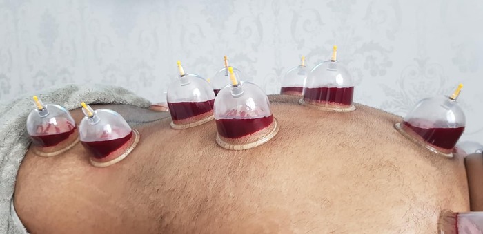 align-shaved-back-cupping