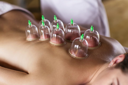 align_cupping_a